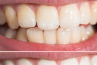 离体牙怎么长期保存 离体牙如何长期保存